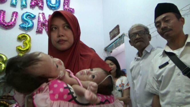 
Berangsur Membaik, Bayi Kembar Siam Asal Probolinggo Masih Butuh Oksigen