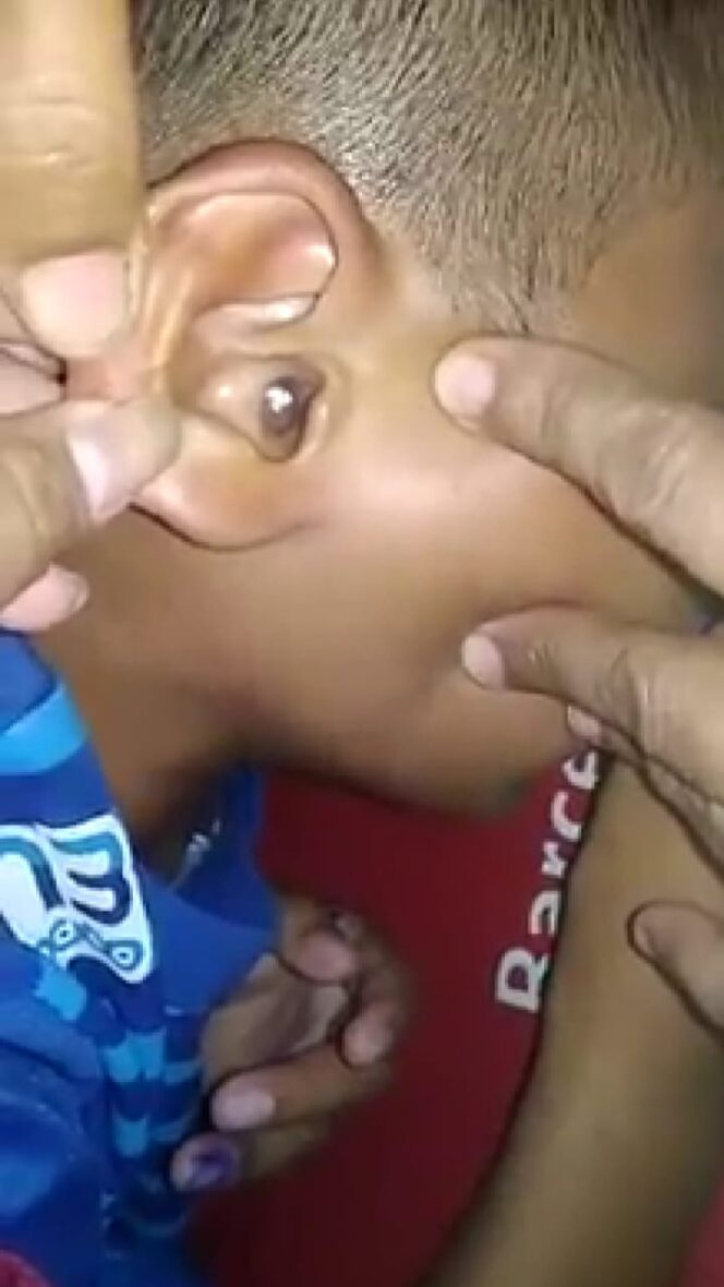 
Heboh, Telinga Bocah SD asal Majalengka Kemasukan Ribuan Semut dan Kertas